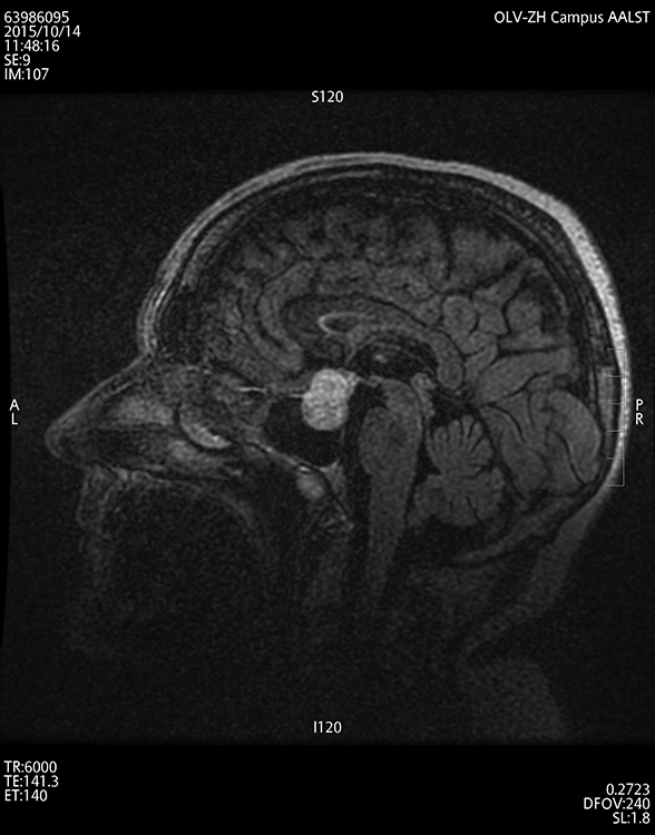 cerveau tumeurs de l hypophyse neurochirurgie olv ziekenhuis aalst